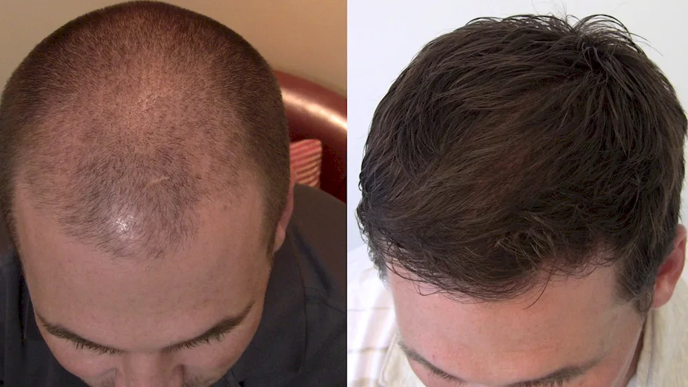 Nicholas 2023 bald