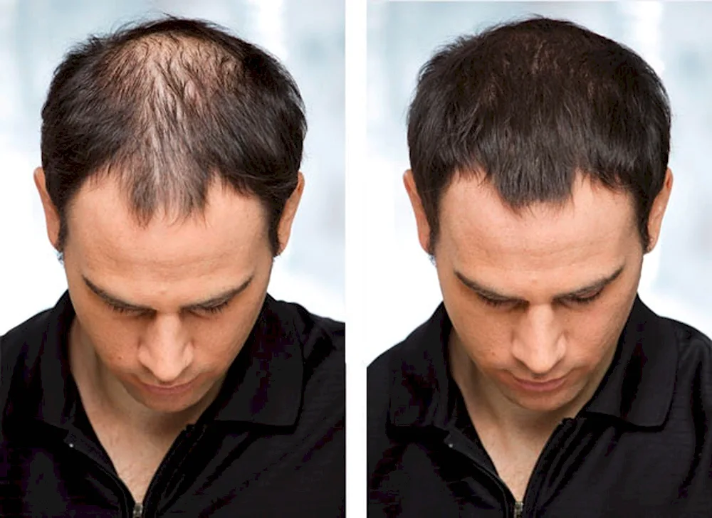 Hairstyles for balding men
