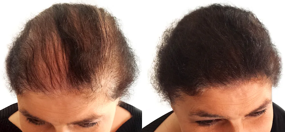 Hirstyles for hair loss