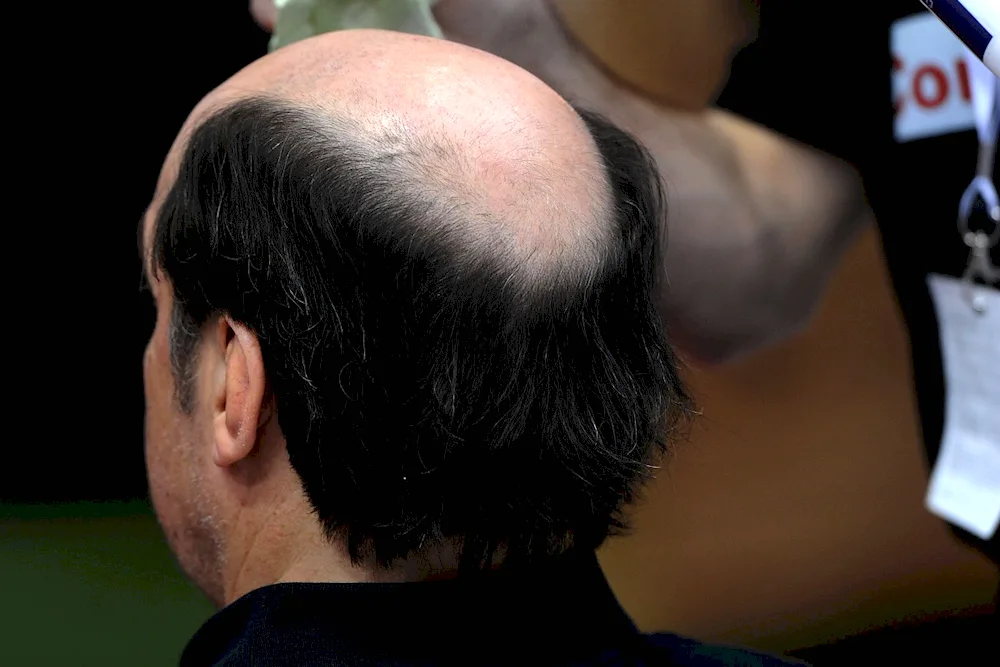 Women's haircuts with baldness