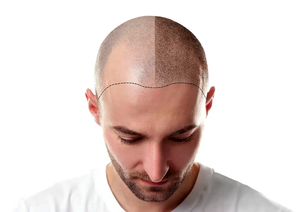 Hairstyles with baldness