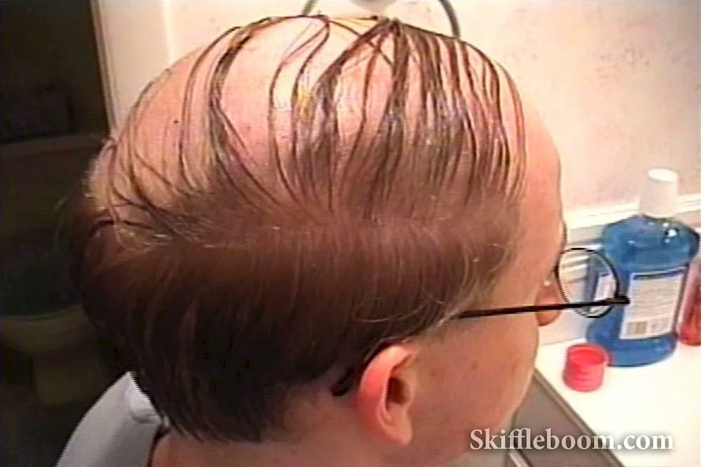 Haircuts with baldness on the forehead