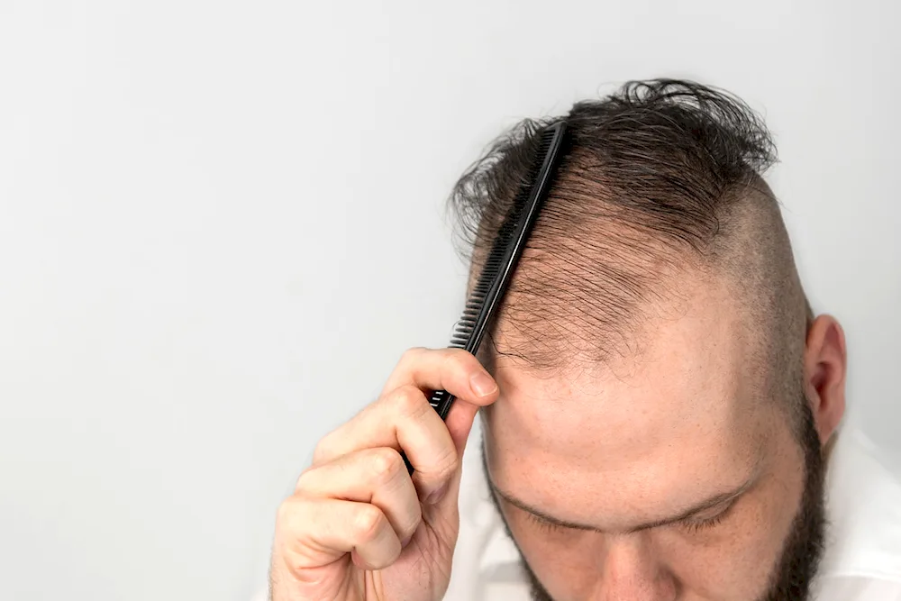 Hairstyles with baldness