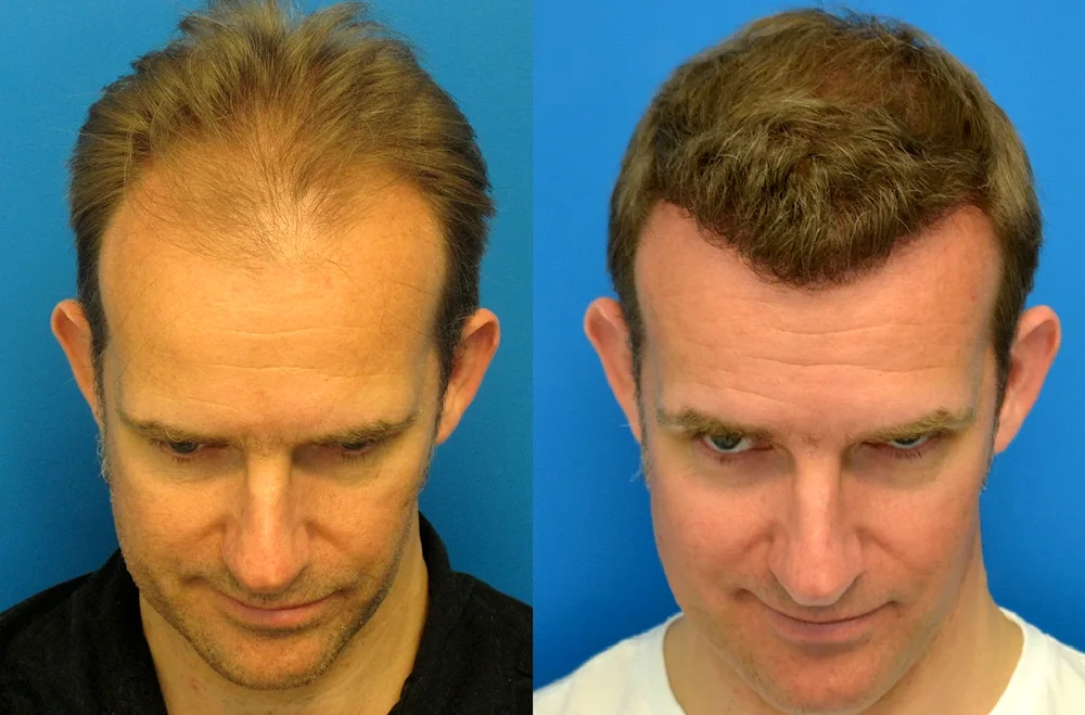 Hair transplants on the head