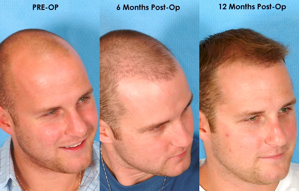 Caboki Hair Thickener