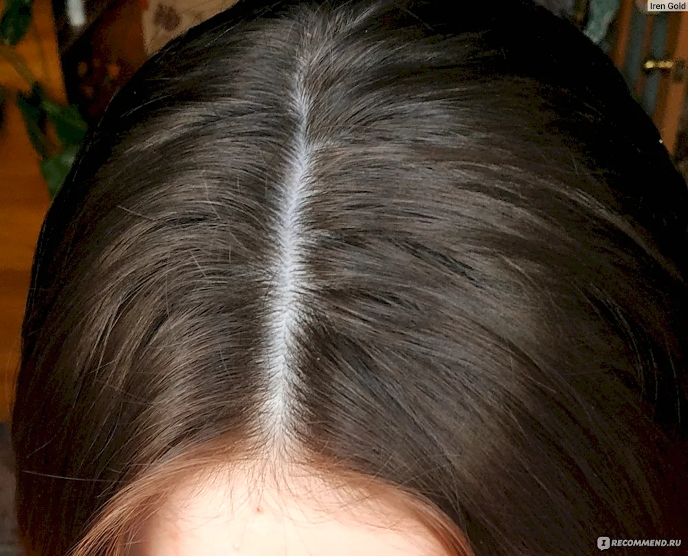 Healthy head parting
