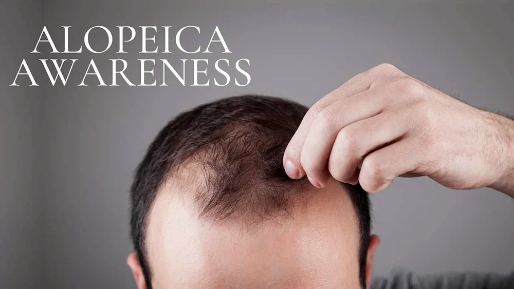 Men's baldness
