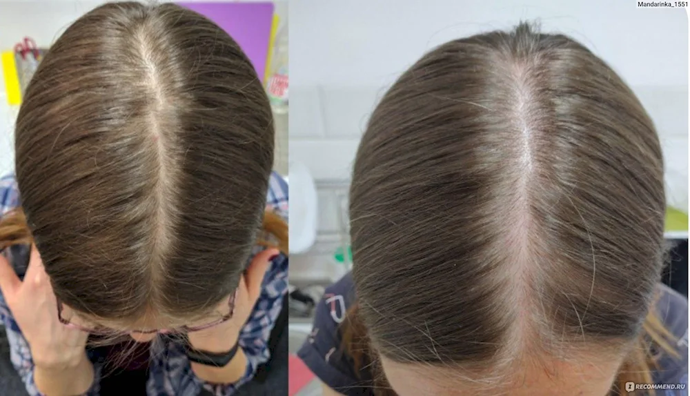Healthy Scalp
