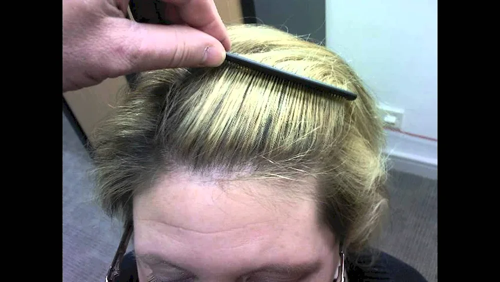 Healthy scalp parting