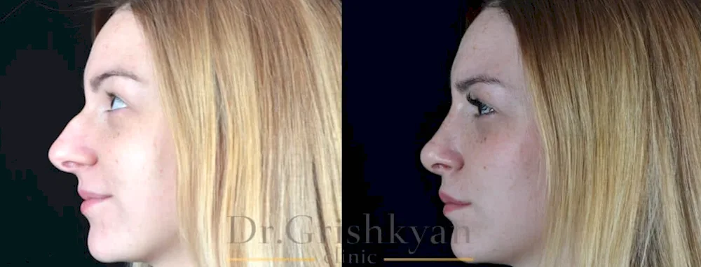 Rhinoplasty for a humped nose