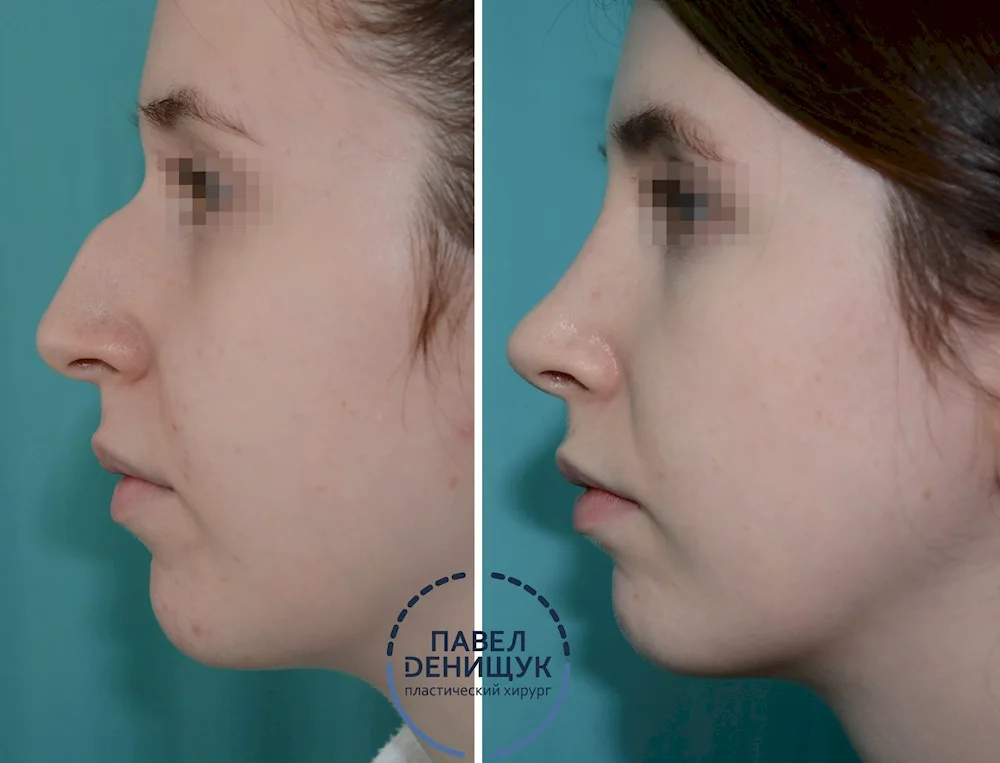 Humpy nose rhinoplasty