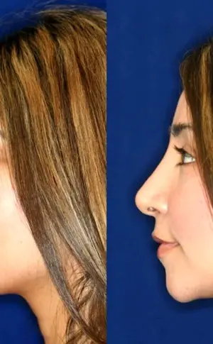 Rhinoplasty for a snub nose