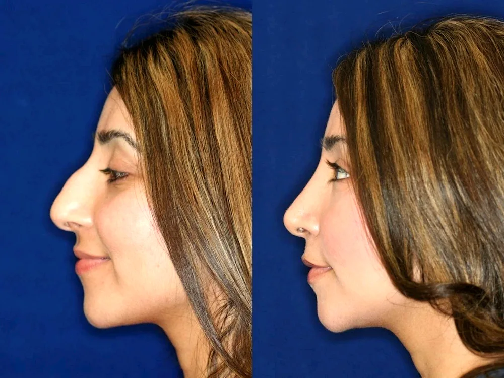 Rhinoplasty for a snub nose