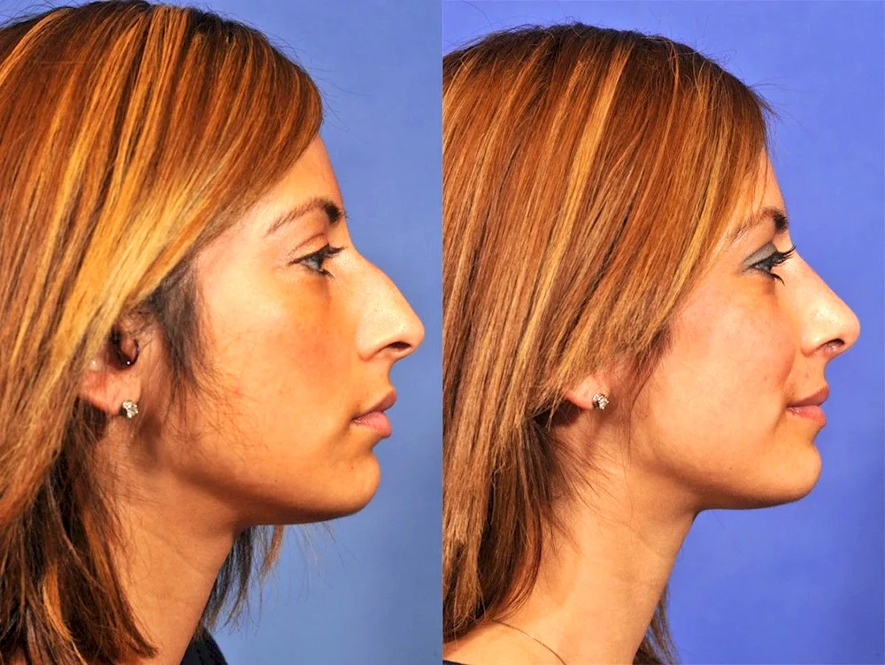 Rhinoplasty with osteotomy