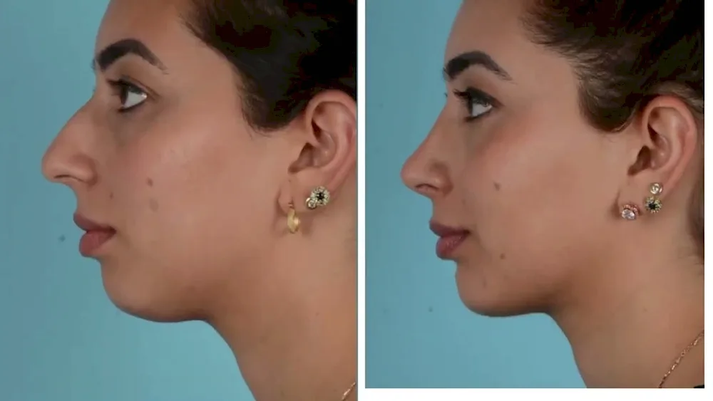 Rhinoplasty in profile