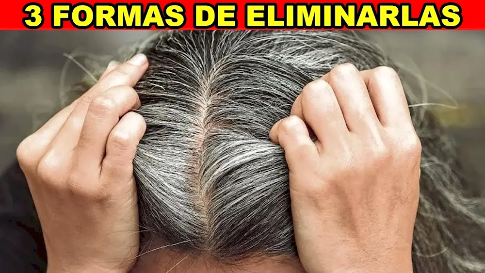 Healthy baldness.