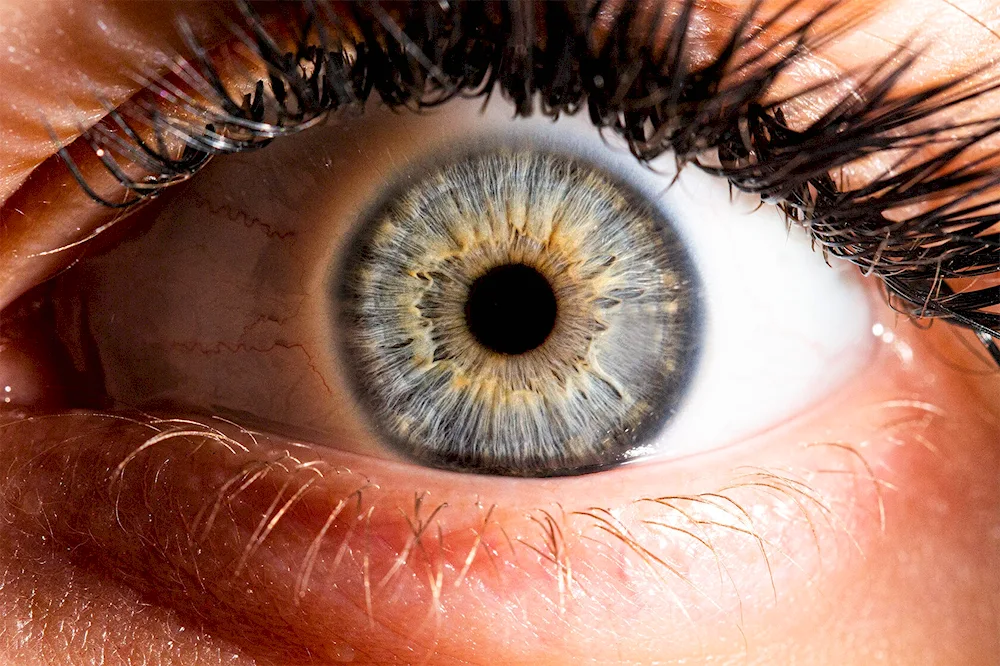 Central heterochromia green Bary