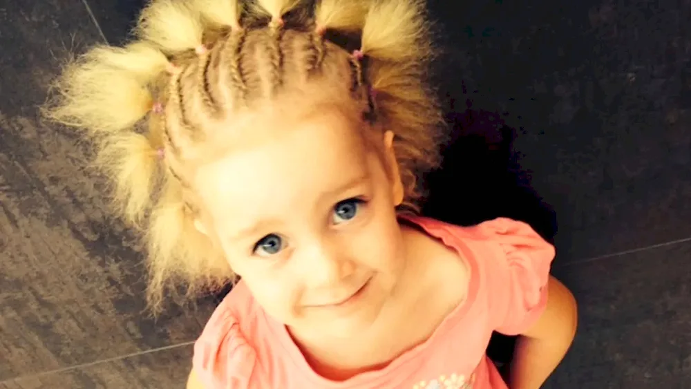 Uncombed hair syndrome
