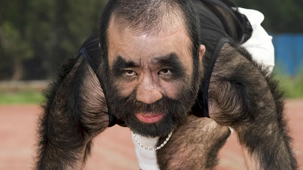 Werewolf syndrome hypertrichosis
