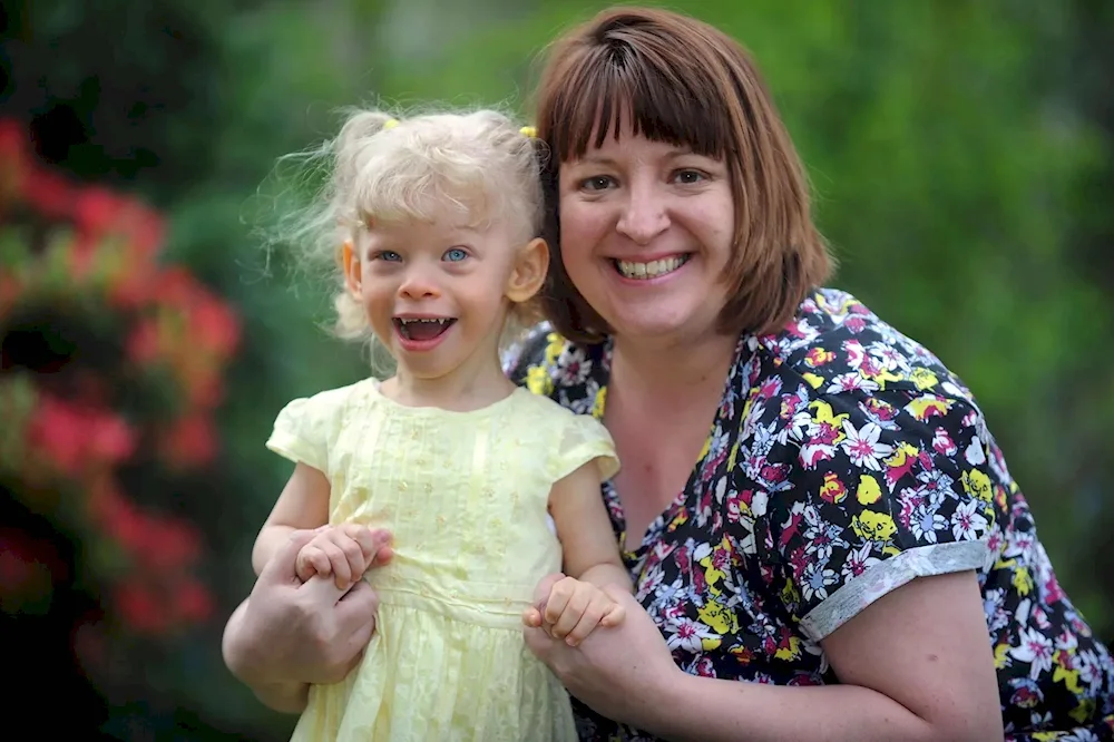 Williams syndrome elf face syndrome