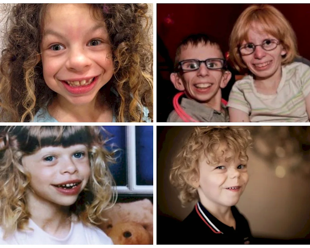 Williams syndrome face elf