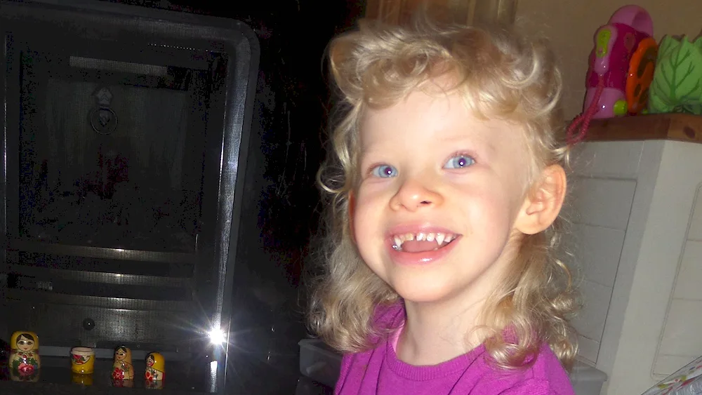 Williams syndrome Williams syndrome Williams syndrome elfa face
