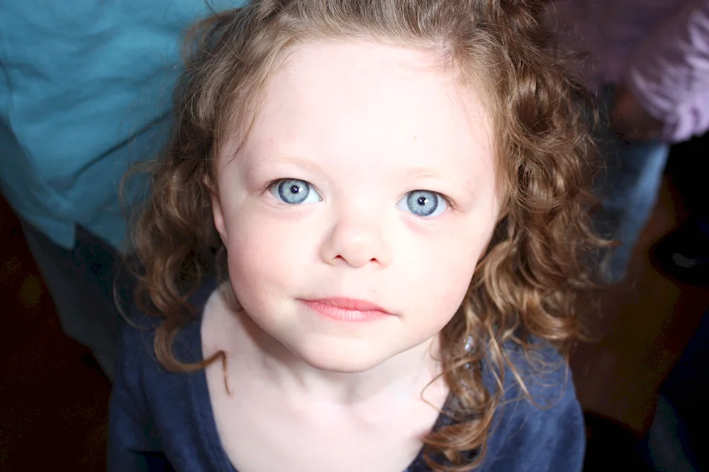 Williams syndrome face elf
