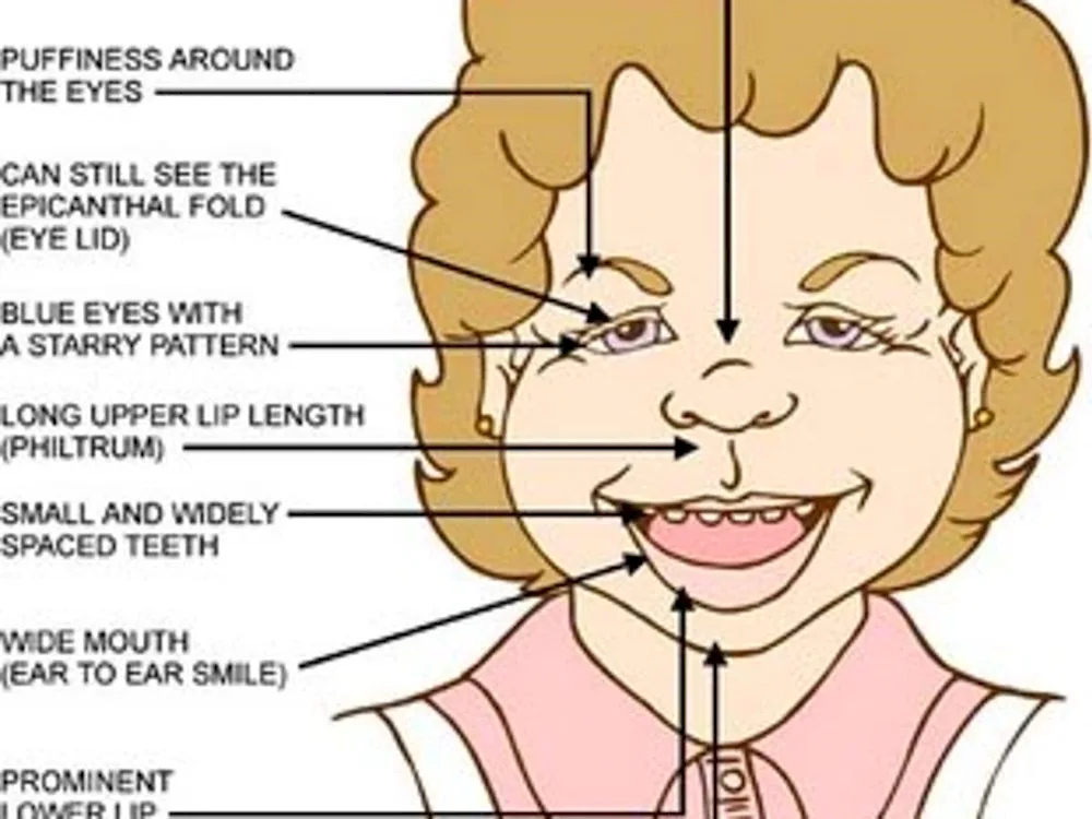 Williams syndrome Boyren's syndrome