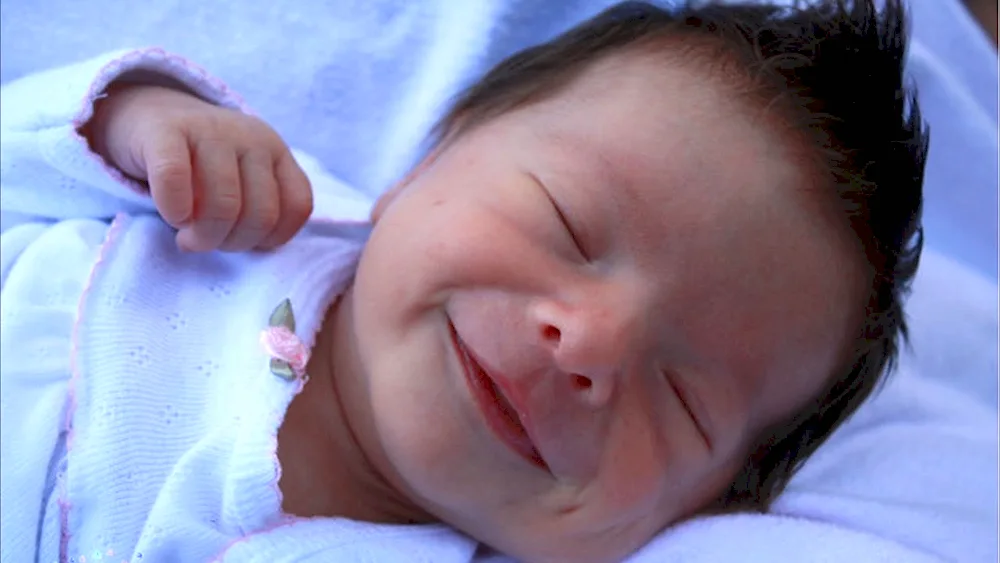 Williams syndrome newborn baby photo