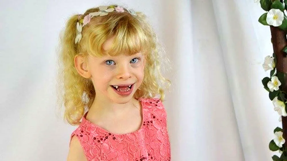Williams syndrome face elf