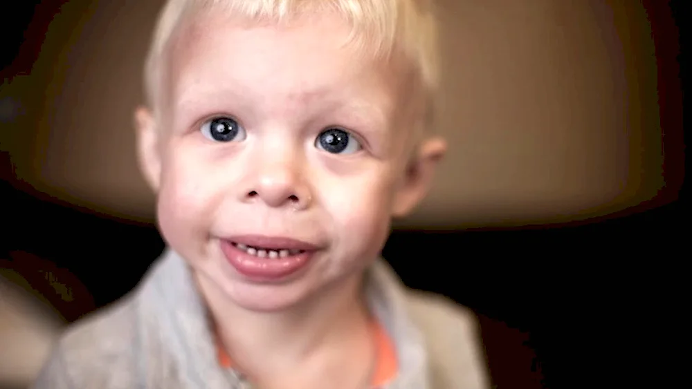 Williams syndrome face Boyren