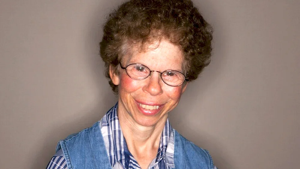 Williams syndrome elfa face