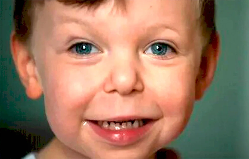 Williams syndrome face elf