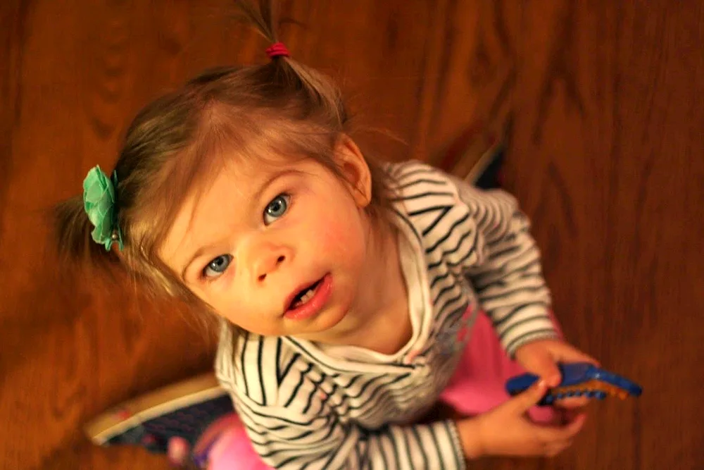 Williams syndrome elf face syndrome