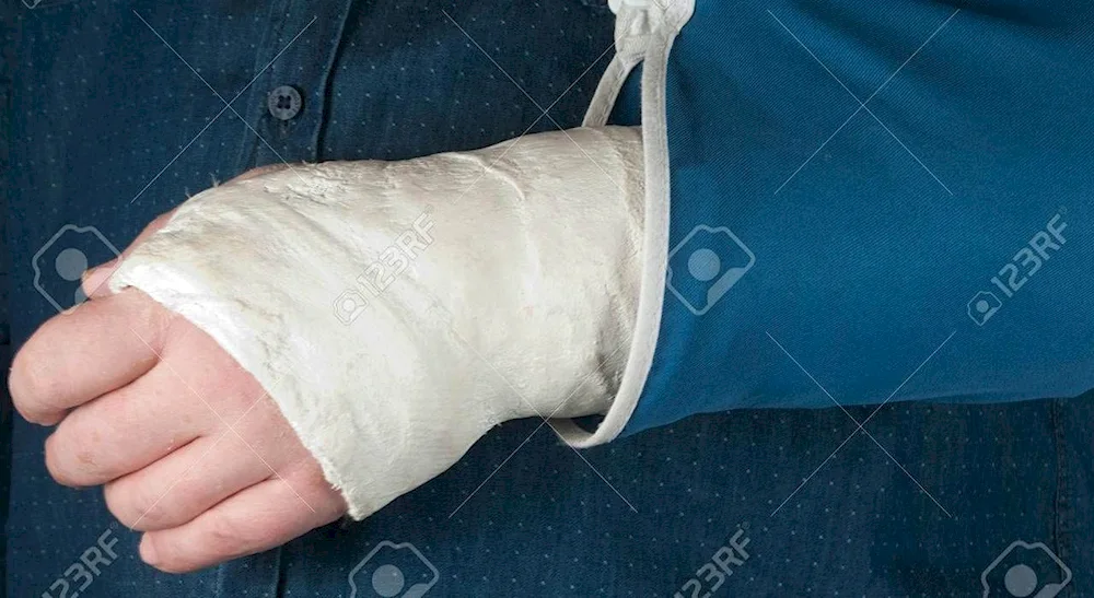 Broken arm in plaster female