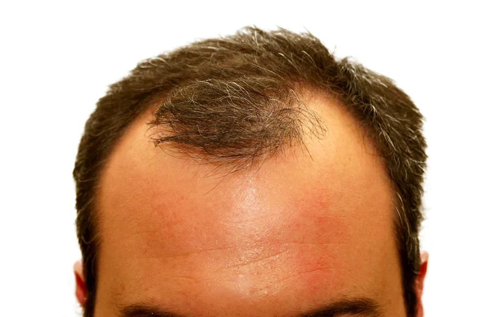 Hairstyles for men with baldness on forehead