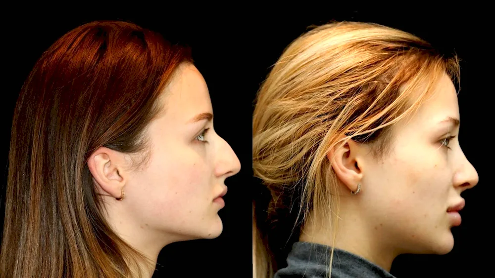 Humped nose in profile