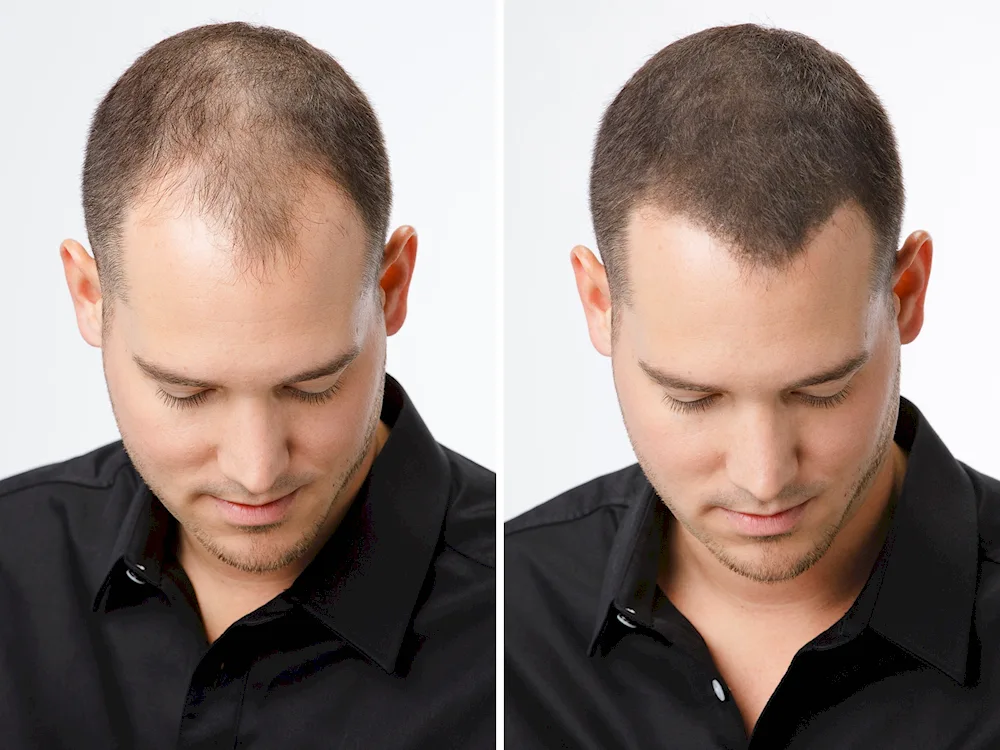 Haircuts with bald patches