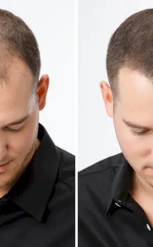 Haircuts with baldness