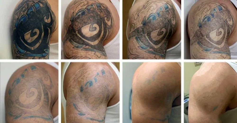 Laser tattoo removal