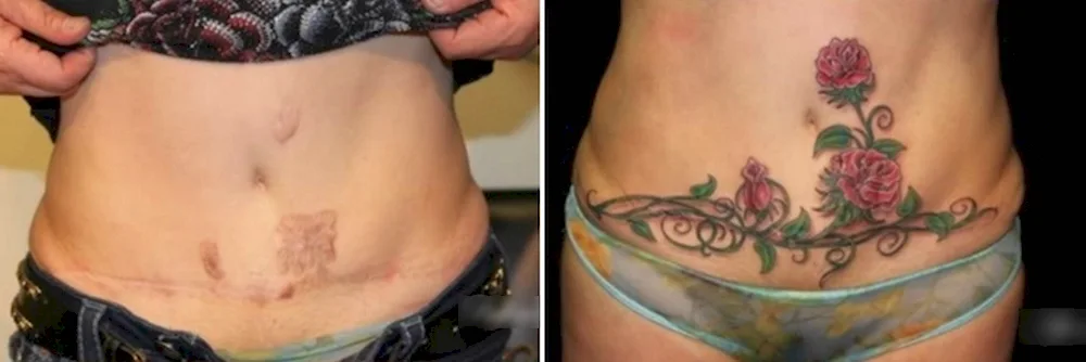 Stretch Marks Covering Tattoo