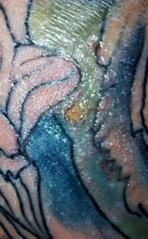 Tattoo crusting