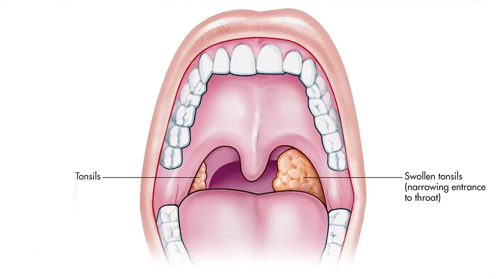 Tonsillitis paratonsillar abscess