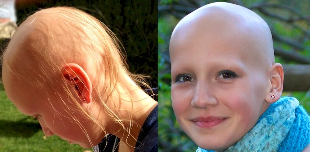 Hair after chemotherapy