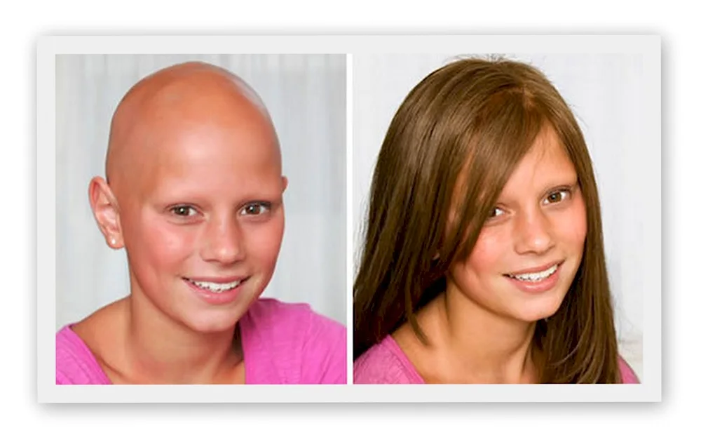 Woman after chemotherapy