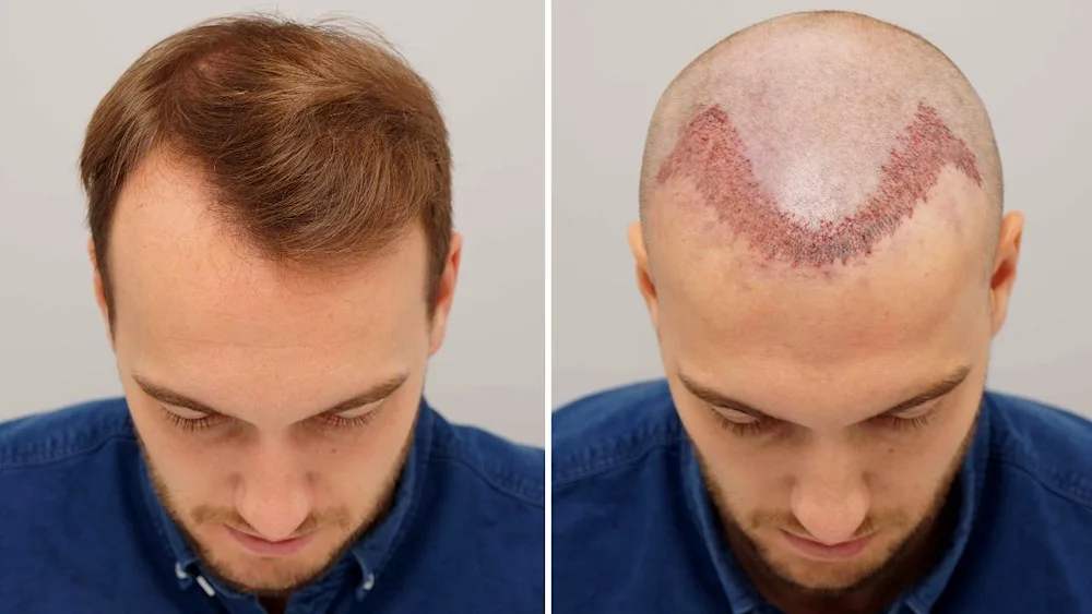 Hair transplant on the head