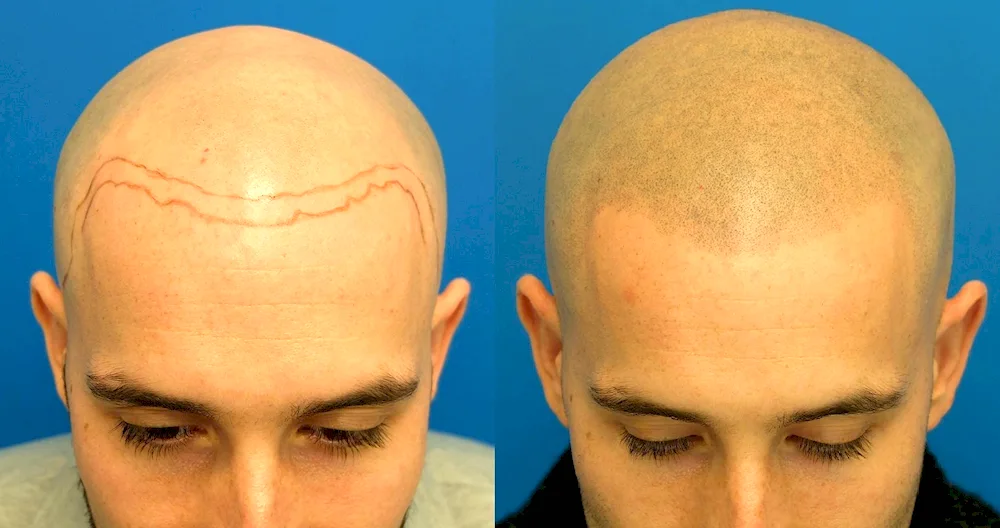 Trichopigmentation scars