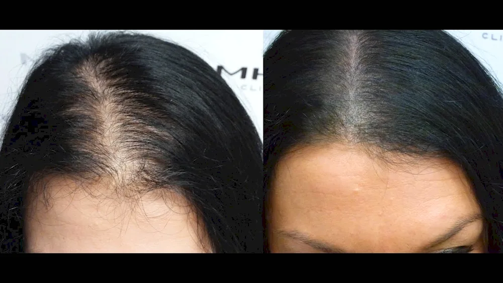 Trichopigmentation baldness
