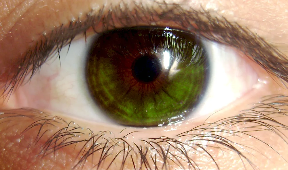 Marsh eye colour heterochromia