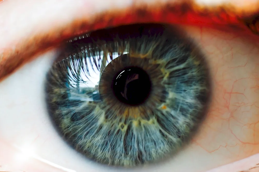 Beautiful eye colour heterochromia